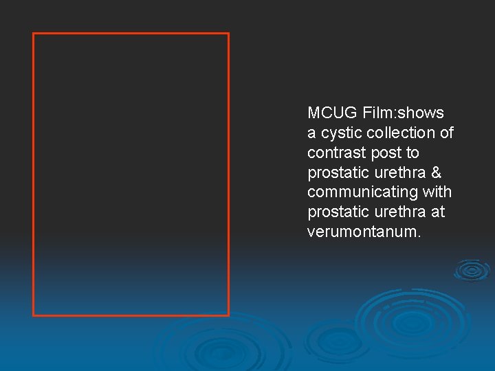 MCUG Film: shows a cystic collection of contrast post to prostatic urethra & communicating