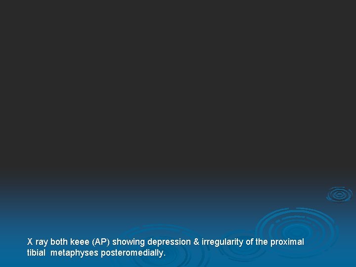 X ray both keee (AP) showing depression & irregularity of the proximal tibial metaphyses