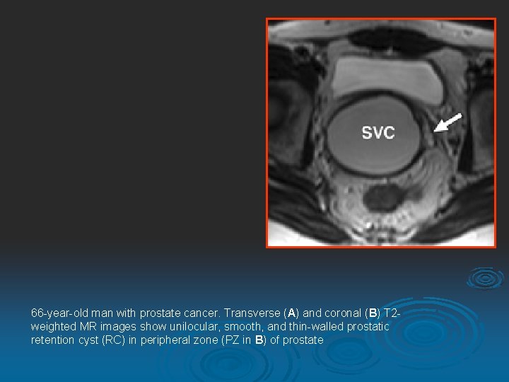 66 -year-old man with prostate cancer. Transverse (A) and coronal (B) T 2 weighted