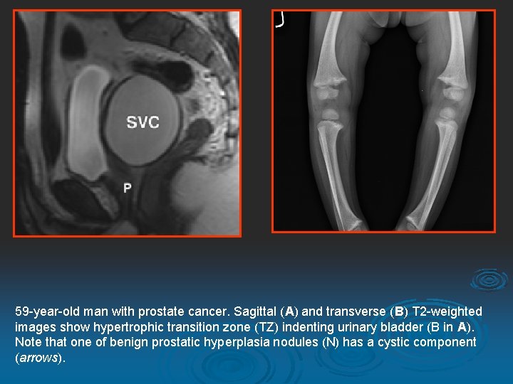 59 -year-old man with prostate cancer. Sagittal (A) and transverse (B) T 2 -weighted