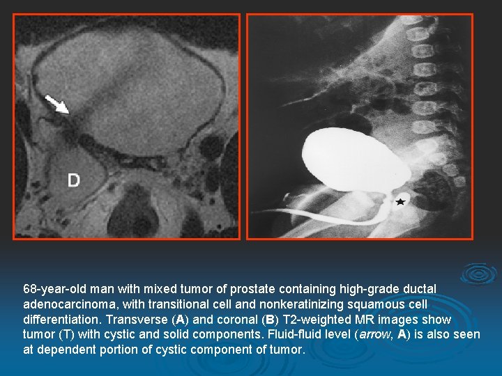 68 -year-old man with mixed tumor of prostate containing high-grade ductal adenocarcinoma, with transitional