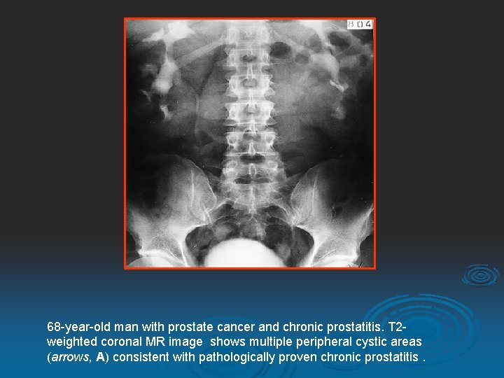 68 -year-old man with prostate cancer and chronic prostatitis. T 2 weighted coronal MR