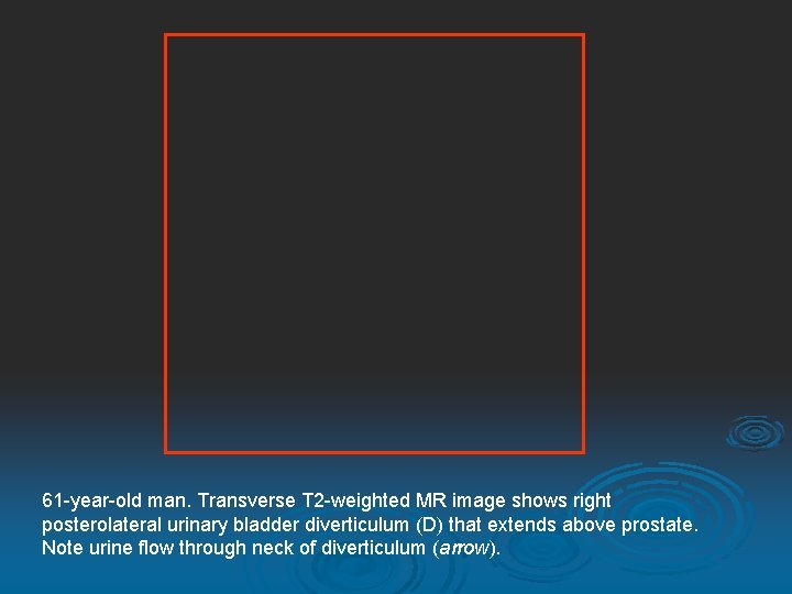 61 -year-old man. Transverse T 2 -weighted MR image shows right posterolateral urinary bladder