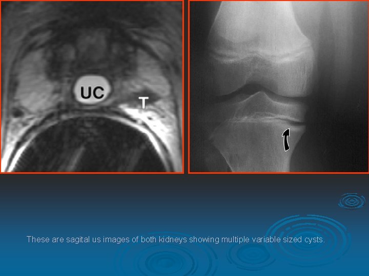 These are sagital us images of both kidneys showing multiple variable sized cysts. 