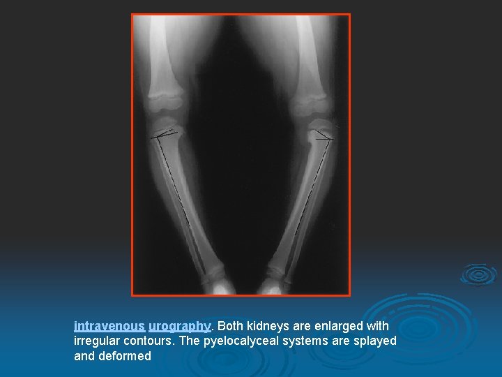 intravenous urography. Both kidneys are enlarged with irregular contours. The pyelocalyceal systems are splayed