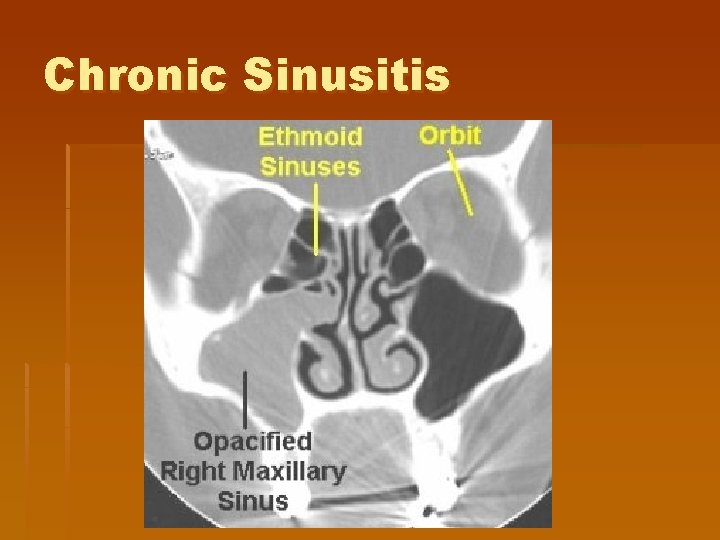 Chronic Sinusitis Chronic Sinusitis