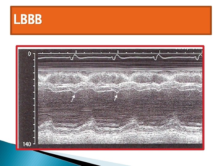LBBB 