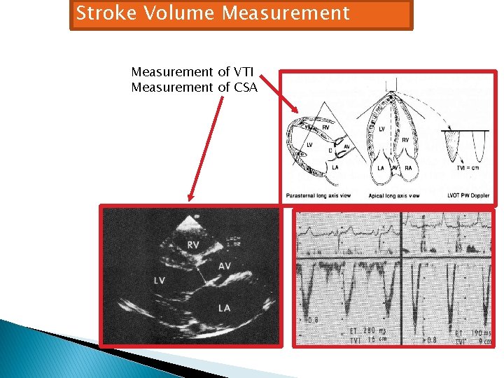Stroke Volume Measurement of VTI Measurement of CSA 