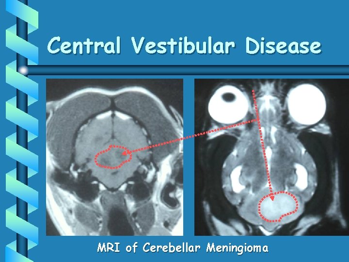 Central Vestibular Disease MRI of Cerebellar Meningioma Central Vestibular Disease MRI of Cerebellar Meningioma