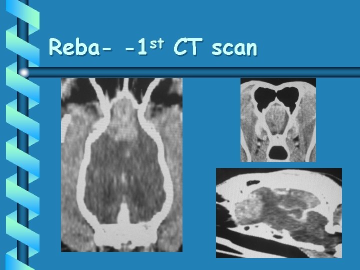 Reba- -1 st CT scan 