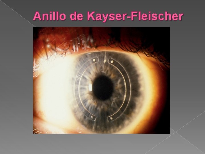 Anillo de Kayser-Fleischer 