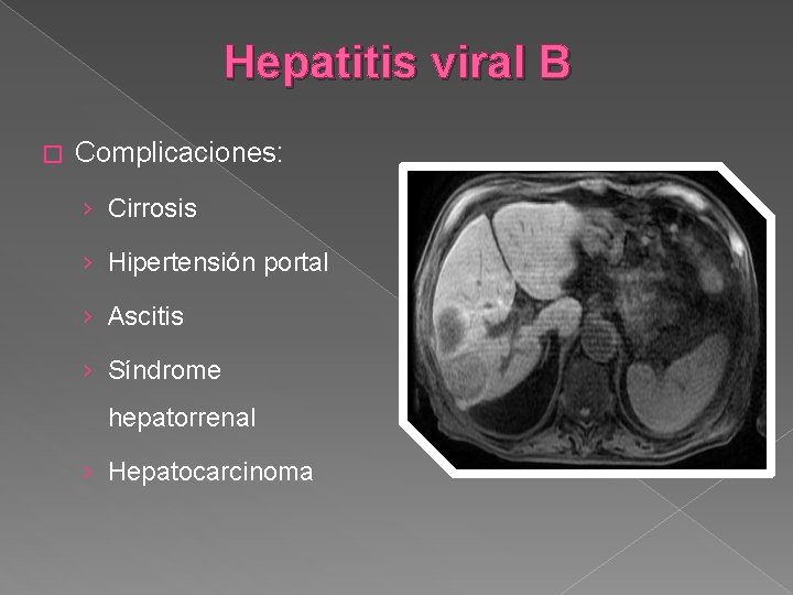 Hepatitis viral B � Complicaciones: › Cirrosis › Hipertensión portal › Ascitis › Síndrome