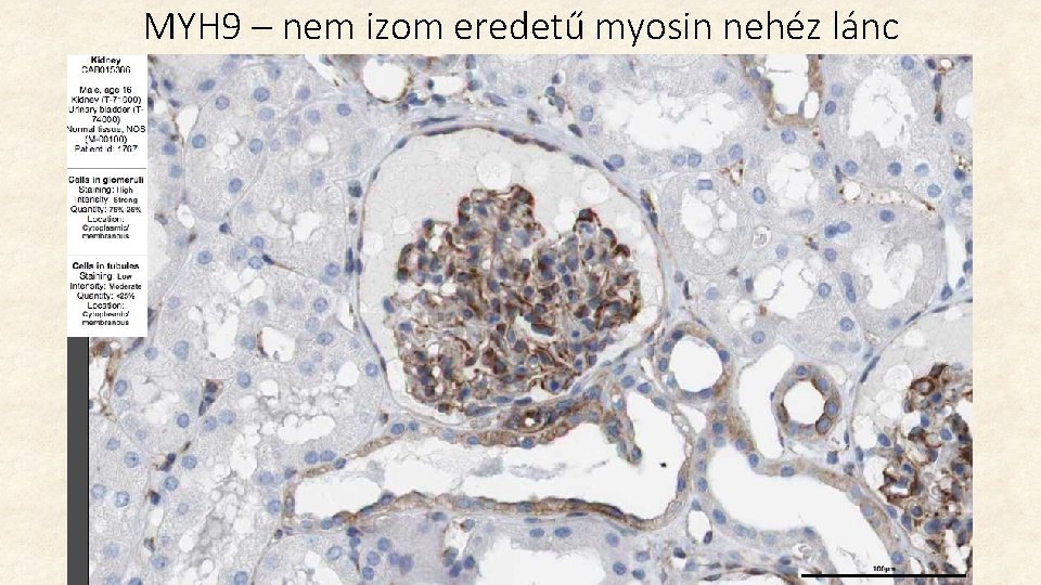 MYH 9 – nem izom eredetű myosin nehéz lánc MYH 9 – nem izom eredetű myosin nehéz lánc