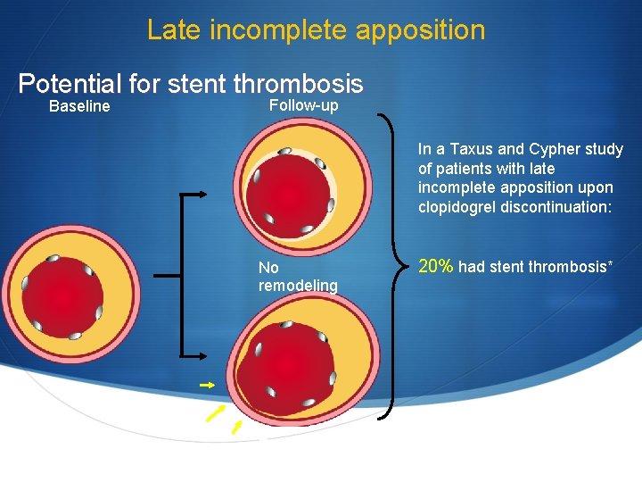 Late incomplete apposition Potential for stent thrombosis Baseline Follow-up In a Taxus and Cypher