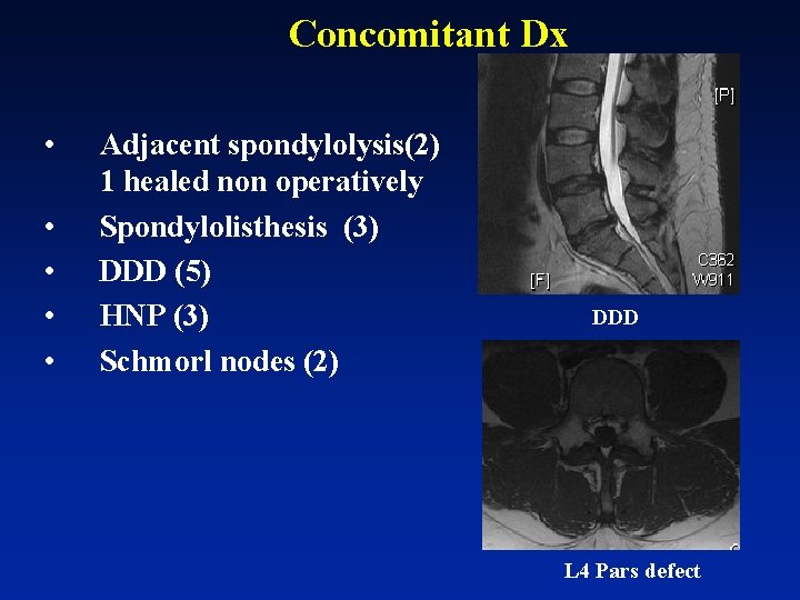 Concomitant Dx • • • Adjacent spondylolysis(2) 1 healed non operatively Spondylolisthesis (3) DDD