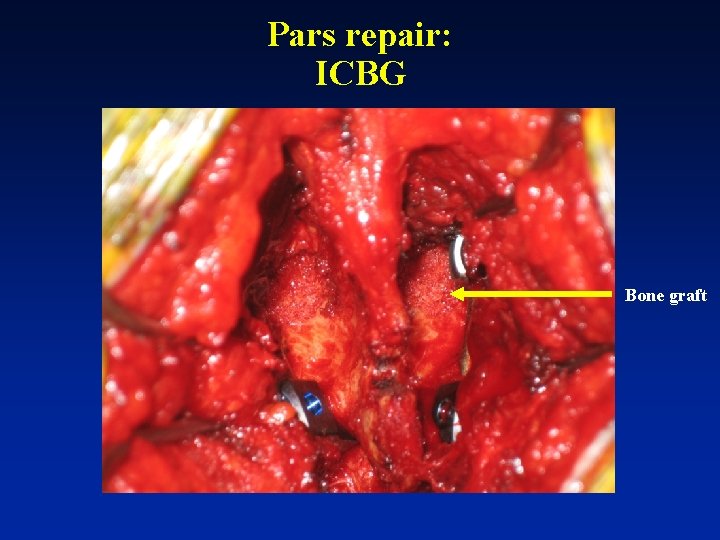 Pars repair: ICBG Bone graft 