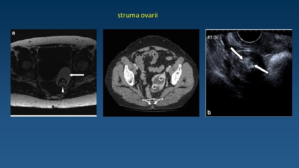 struma ovarii 