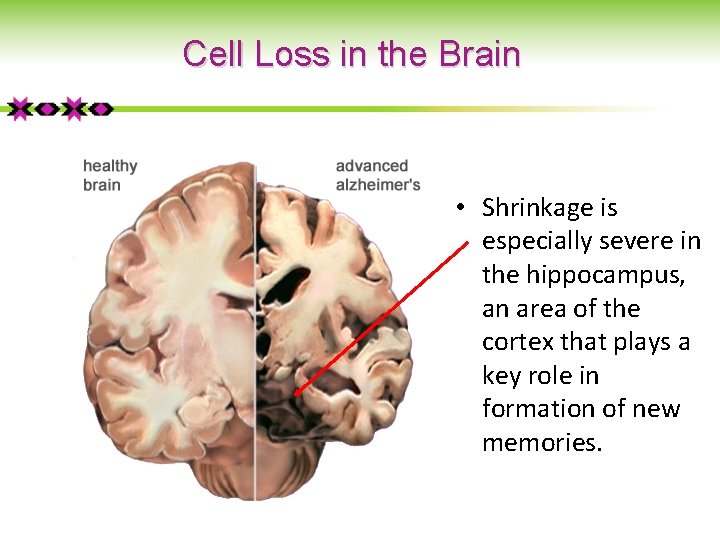 Cell Loss in the Brain • Shrinkage is especially severe in the hippocampus, an