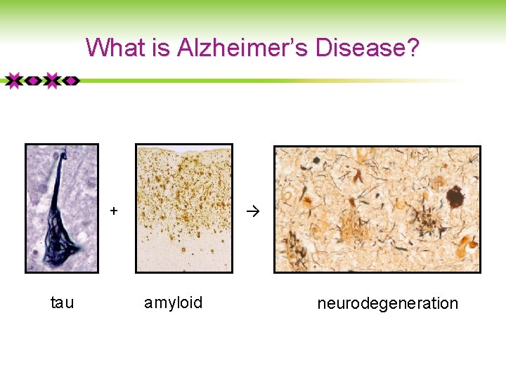 What is Alzheimer’s Disease? + tau → amyloid neurodegeneration 