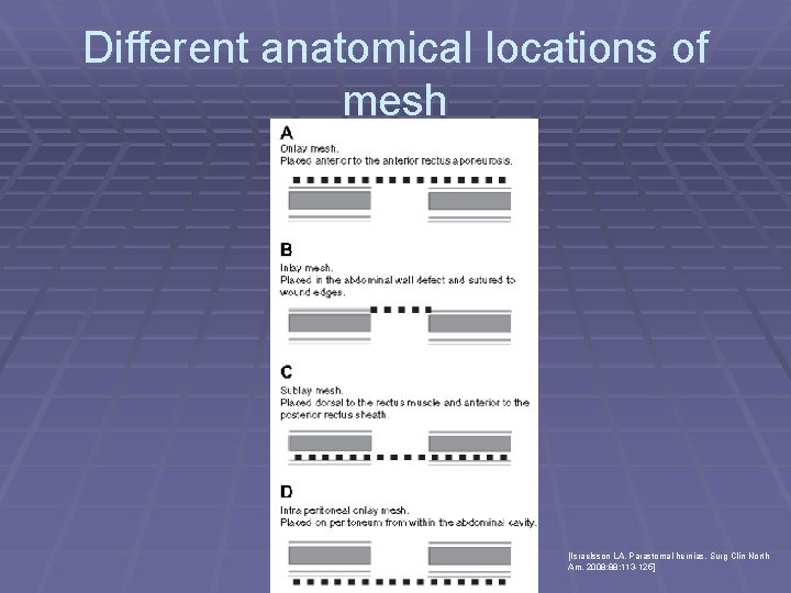 Different anatomical locations of mesh [Israelsson LA. Parastomal hernias. Surg Clin North Am. 2008;