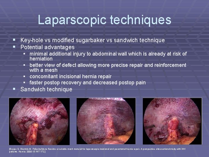 Laparscopic techniques § Key-hole vs modified sugarbaker vs sandwich technique § Potential advantages §