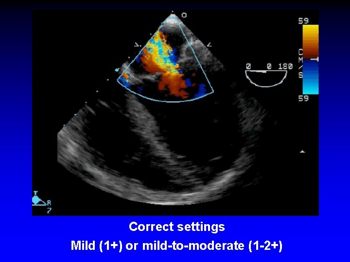 Correct settings Mild (1+) or mild-to-moderate (1 -2+) Correct settings Mild (1+) or mild-to-moderate (1 -2+)
