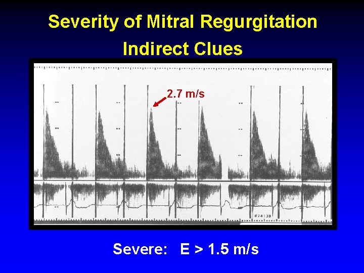 Severity of Mitral Regurgitation Indirect Clues 2. 7 m/s Severe: E > 1. 5 Severity of Mitral Regurgitation Indirect Clues 2. 7 m/s Severe: E > 1. 5