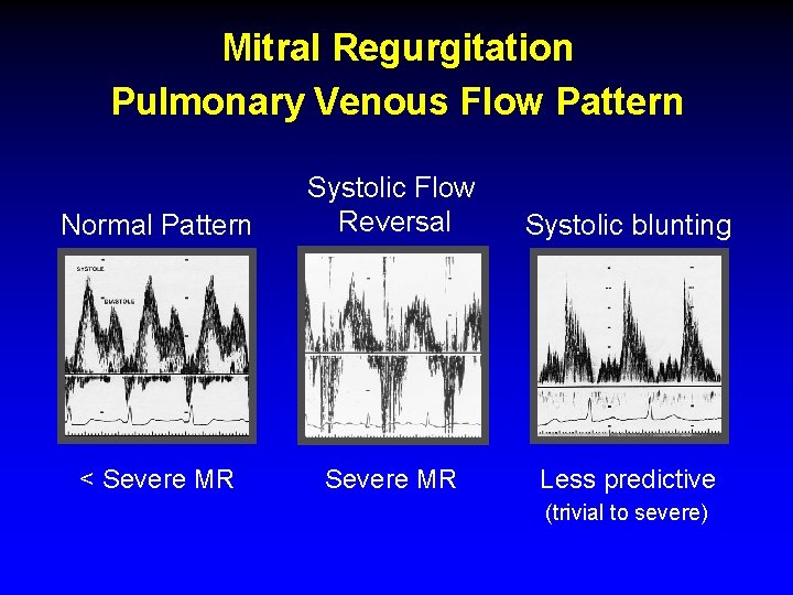 Mitral Regurgitation Pulmonary Venous Flow Pattern Normal Pattern Systolic Flow Reversal Systolic blunting < Mitral Regurgitation Pulmonary Venous Flow Pattern Normal Pattern Systolic Flow Reversal Systolic blunting <