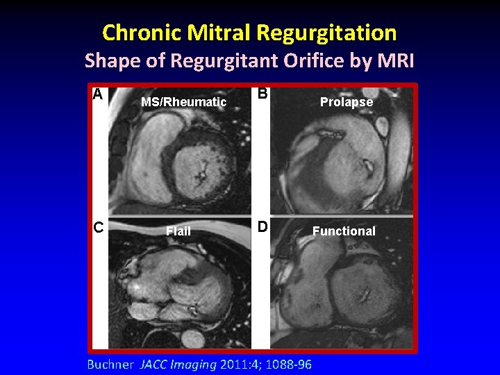 Chronic Mitral Regurgitation Shape of Regurgitant Orifice by MRI A C MS/Rheumatic Flail B Chronic Mitral Regurgitation Shape of Regurgitant Orifice by MRI A C MS/Rheumatic Flail B