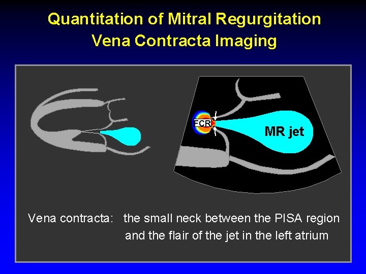 Quantitation of Mitral Regurgitation Vena Contracta Imaging FCR MR jet Vena contracta: the small Quantitation of Mitral Regurgitation Vena Contracta Imaging FCR MR jet Vena contracta: the small
