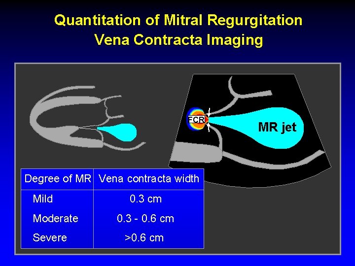 Quantitation of Mitral Regurgitation Vena Contracta Imaging FCR Degree of MR Vena contracta width Quantitation of Mitral Regurgitation Vena Contracta Imaging FCR Degree of MR Vena contracta width
