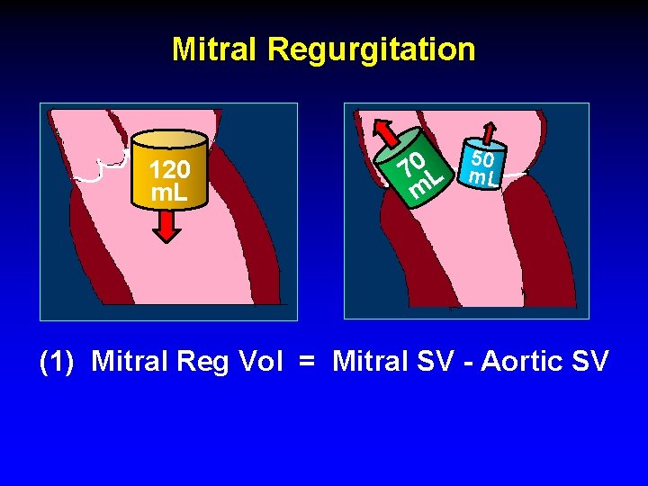 Mitral Regurgitation 120 m. L 50 0 7 L m (1) Mitral Reg Vol Mitral Regurgitation 120 m. L 50 0 7 L m (1) Mitral Reg Vol