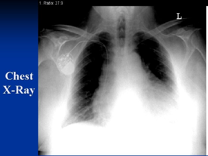 Chest X-Ray 