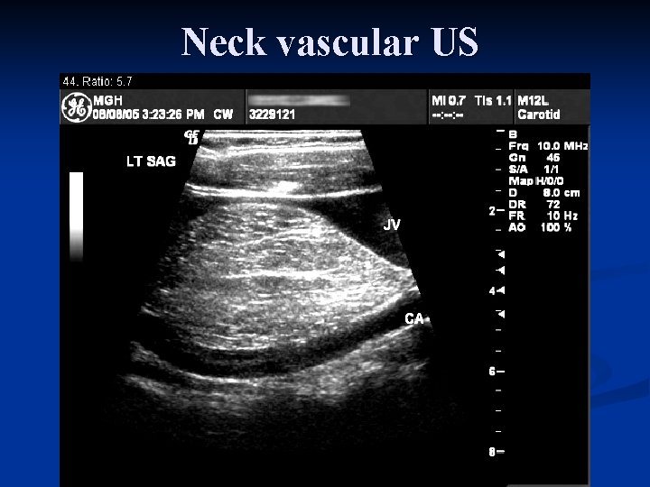 Neck vascular US 