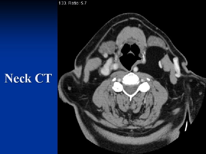 Neck CT 