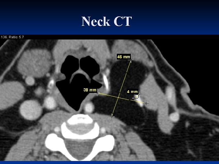 Neck CT 