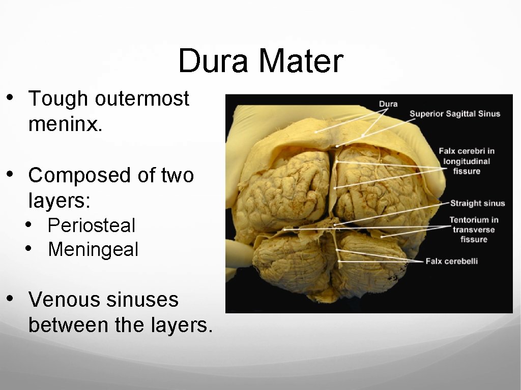 Dura Mater • Tough outermost meninx. • Composed of two layers: • Periosteal •