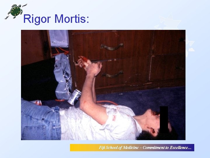 Rigor Mortis: Fiji School of Medicine – Commitment to Excellence… Rigor Mortis: Fiji School of Medicine – Commitment to Excellence…