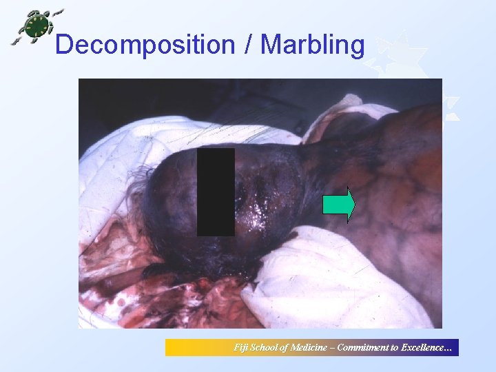 Decomposition / Marbling Fiji School of Medicine – Commitment to Excellence… Decomposition / Marbling Fiji School of Medicine – Commitment to Excellence…