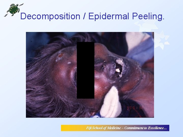 Decomposition / Epidermal Peeling. Fiji School of Medicine – Commitment to Excellence… Decomposition / Epidermal Peeling. Fiji School of Medicine – Commitment to Excellence…