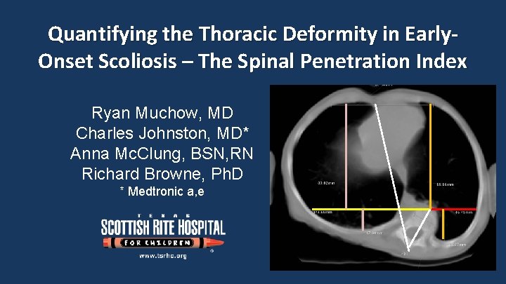 Quantifying the Thoracic Deformity in Early. Onset Scoliosis – The Spinal Penetration Index Ryan
