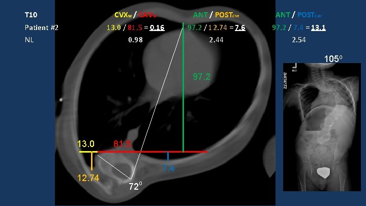 T 10 Patient #2 NL CVXW / CAVW ANT / POSTCVX ANT / POSTCAV