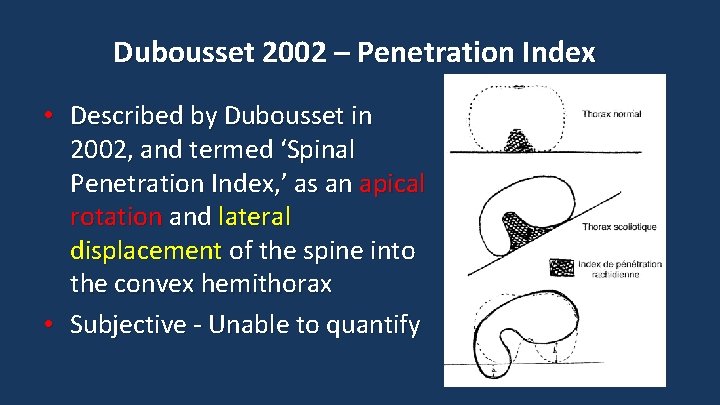 Dubousset 2002 – Penetration Index • Described by Dubousset in 2002, and termed ‘Spinal