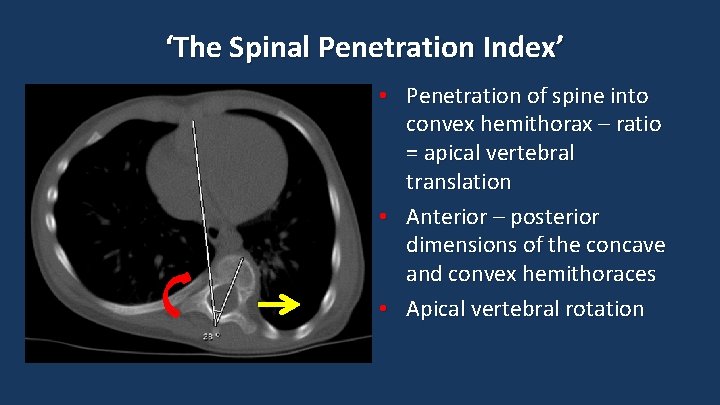‘The Spinal Penetration Index’ • Penetration of spine into convex hemithorax – ratio =