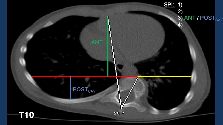 SPI: 1) 2) 3) ANT / POSTCAV 4) ANT POSTCAV T 10 