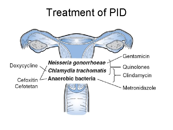 Treatment of PID 