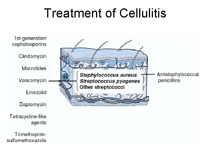 Treatment of Cellulitis 