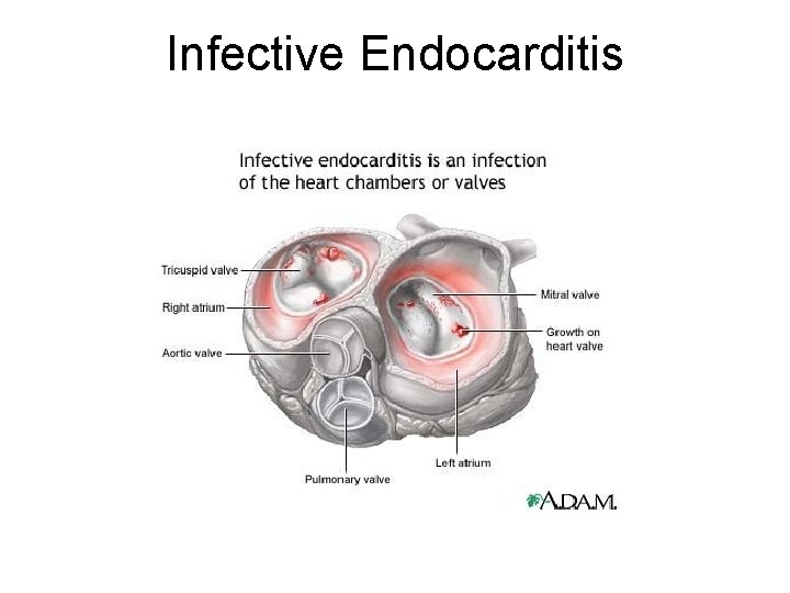 Infective Endocarditis 