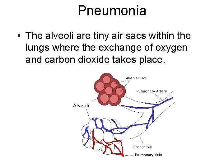 Pneumonia • The alveoli are tiny air sacs within the lungs where the exchange