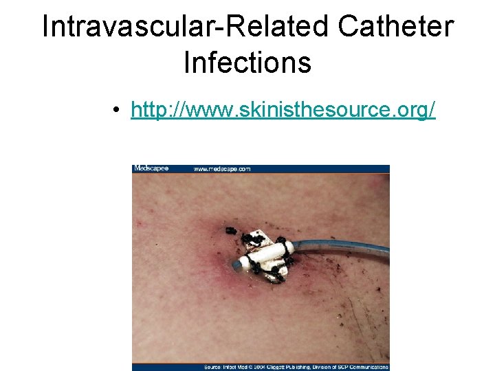 Intravascular-Related Catheter Infections • http: //www. skinisthesource. org/ 